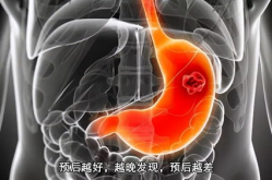 骨癌晚期还能活多久,治疗与生活质量的平衡